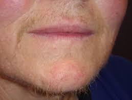 It's your body (and face) after all. Hirsutism Dermnet Nz