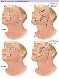Facelift with SMAS Flaps