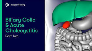 Image result for Biliary Colic