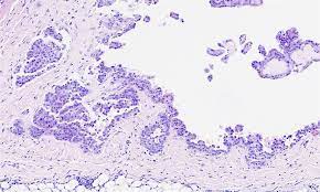 Maybe you would like to learn more about one of these? Pathology Outlines Mesothelioma Pleura Epithelioid