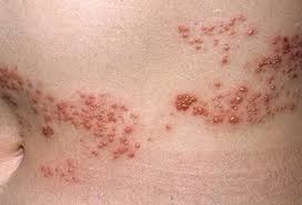 Image result for shingles in children