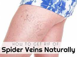 How To Get Rid Of Spider Veins Naturally Spider Veins Get Rid Of Spider Veins Veins Treatment