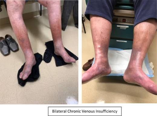 Chronic Venous Insufficiency - an overview | ScienceDirect Topics