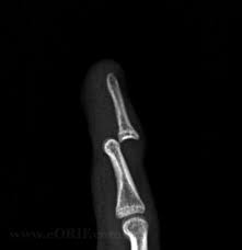 Image result for DIP Dislocation