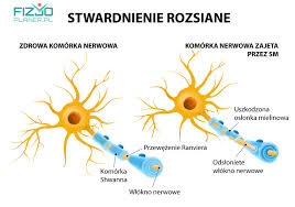 Stwardnienie rozsiane powoduje nieprawidłowy przekaz impulsów nerwowych i prowadzi do inwalidztwa. Pin On Schematy Medyczne