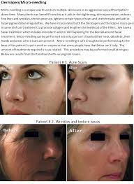 Micropen® elite can help improve the appearance of hyperpigmentation as well as uneven skin tone, acne scars, traumatic scars, and. 27 Dermapen Ideas Dermapen Microneedling Skin Needling