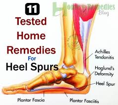 11 Tested Natural Home Remedies For Heel Spurs Home Remedies Blog Heel Spurs Heal Spur Remedies Heel Spurs Remedies