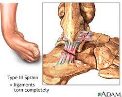 Strained ankle tendon & ligaments: Inversion Ankle Sprains Gymnastics Injuries