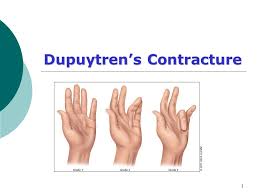 We did not find results for: Dupuytren S Contracture Ppt Video Online Download