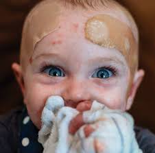 Building a Faster Path to Curing Epidermolysis Bullosa