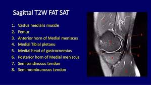Although not dangerous, can cause pain if exposure increases 50. Mri Musculo Skeletal Section Sagittal T2 Knee Anatomy