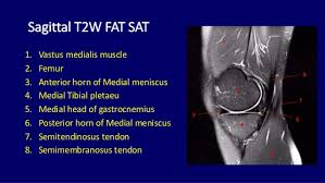 The muscles that affect the knee's movement run along the thigh and calf. Mri Musculo Skeletal Section Sagittal T2 Knee Anatomy