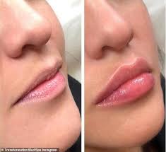 Lip Threading Is The Trend Tipped To Take Over Fillers Botox Lips Lip Fillers Perfect Lips