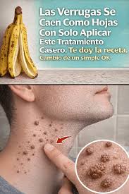 Las Verrugas Se Caen Como Hojas Con Solo Aplicar Este Tratamiento Casero:  El Secreto de la Cáscara de Guineo... ver mas