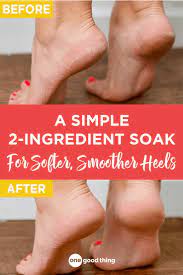 This Strange Sounding Foot Soak Of Listerine And Vinegar Works Wonders To Smooth And Soften Dry Cracked Feet Dry Heels Foot Soak Vinegar Cracked Feet Remedies