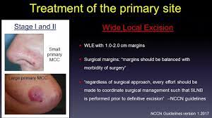 Treatments are often highly individualized, depending on a patient's general health, as well as the tumor's location, size, depth, and degree of spread. Update In Medical Treatment Of Merkel Cell Carcinoma Youtube