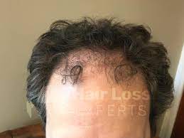 In addition, some people have an uncommon psychiatric disorder (trichotillomania) in which compulsive. Home Hair Loss Experts