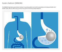 orbera gastric balloon bariatric