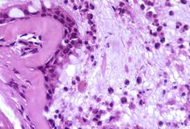 Maybe you would like to learn more about one of these? Datei Charcot Leyden Crystal Asthma Jpg Wikibooks Sammlung Freier Lehr Sach Und Fachbucher