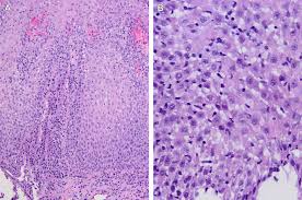 Esophagitis may cause odynophagia and even esophageal hemorrhage, which is usually occult but can be massive. Other Forms Of Esophagitis Surgical Pathology Clinics
