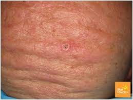 It's really quite simple when you think about it. Skin Cancer On Scalp Skin Check Waskin Check Wa