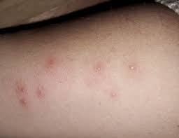 Granitos Vesiculosos Que Pican O Molestan Dermatologo Net