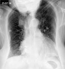 In nederland is tot nu toe echter geen enkel geval van legionellose toegeschreven aan l. Pneumonie Chez Le Sujet Age Y A T Il Des Specificites