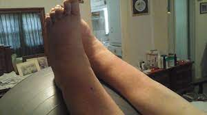 6 Steps To Put Compression Hose Socks On Easy Fast Tips From A Physical Therapist