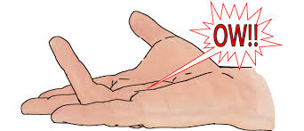 Dupuytren Pain And Itching Dupuytren Research Group