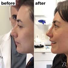 I Tried Out Nonsurgical Rhinoplasty And This Is What Happened Society19 Nonsurgical Nose Job Nose Contouring Nose Fillers