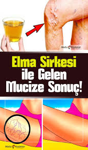 Her Gun Elma Sirkesi Tuketmek Icin 10 Harika Sebep Saglik Dogal Saglik Saglik Urunleri