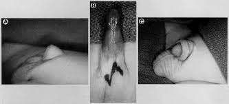 A NEW TECHNIQUE FOR CORRECTION OF THE HIDDEN PENIS IN CHILDREN AND ADULTS -  ScienceDirect