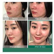 Glycolic acid, lactic acid, tartaric acid and citric acid. The Ordinary Aha 30 Bha 2 Peeling Solution 30ml Niceone