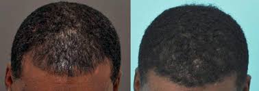 Though hair thinning can be related to genetics and is a natural phenomenon, there can be certain factors that can aggravate the situation. African American Hair Transplant In Miami Care4hair