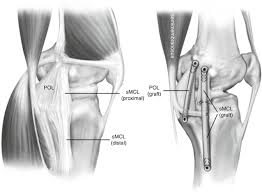 Your mcl could stretch or tear if you get injured while playing certain contact sports. Treatment Of Mcl Injury In Combined Acl Mcl Injury Springerlink
