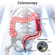 Having a colonoscopy to detect hidden colon cancer can be a lifesaver. Colonoscopy Preparation Risks Age Recovery Diet Sedation
