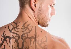 Depending on the size of the tattoo, surgical removal may range between $150 and $350, according to st. Home Tattoo Removal Olympic Dermatology Laser Clinic