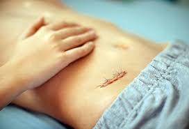 If your surgery is scheduled for a monday, they'll call you on the friday before. How Long Does It Take For A Child To Recover From An Appendectomy