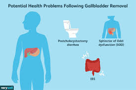 Most of the time people have them and will never know. Gallbladder Removal What To Eat For Better Management