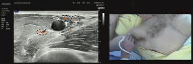 Image result for Axillary Nerve Block