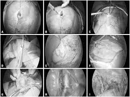 Continual monitoring with your doctor is a good idea if you do not have any other symptoms (pain, nausea, etc.) good luck! Xmlinkhub
