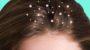 Thinning hair is about your hair. What Causes Dandruff The Truth Behind 9 Common Dandruff Myths Self