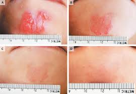 Image result for Paromomycin