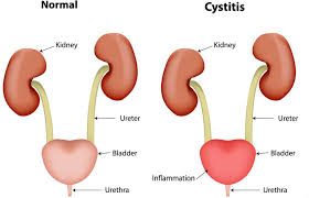 Totul Despre Infectiile Urinare Cauze Simptome Tratament Medlife