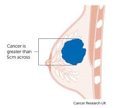 Inflammatory breast cancer is an advanced cancer because it has already spread at diagnosis. Tnm Staging For Breast Cancer Breast Cancer Cancer Research Uk