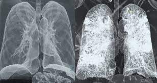 The scan is painless and takes about 10 to 30 minutes. Vancouver Home To World S Largest Global Review Of Covid Ct Scans And X Rays Techcouver Com