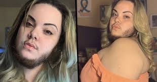 Why women grow facial hair. Woman With Excess Facial Hair Caused By Pcos Grows Out Full Beard Unilad