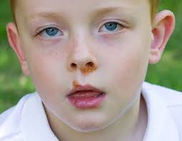 Vous voyez apparaître des boutons sur le visage de bébé ? Impetigo Vous Avez Remarque L Apparition De Boutons Autour De Son Nez Ou De Sa Bouche