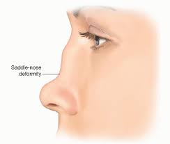 Saddle Nose Deformity