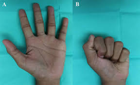 Jun 21, 2013 · : Cureus Irreducible Dorsal Distal Interphalangeal Joint Dislocation Of Finger A Case Report And Perspectives On Management